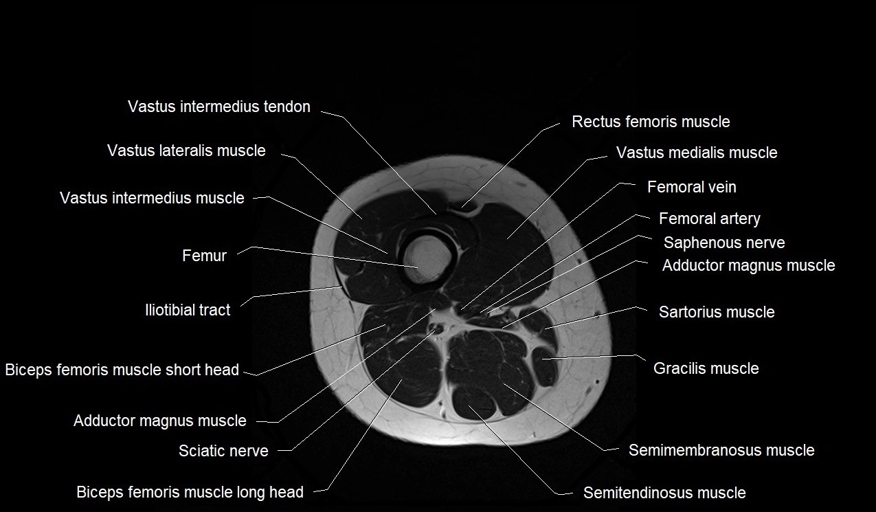 MRI thigh cross sectional anatomy image 43.webp